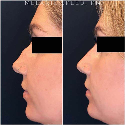 Rhinoplasty before photo