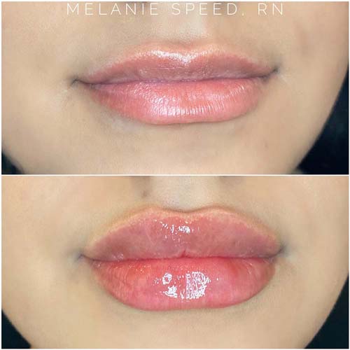Flawless MedSpa lip filler after — Las Vegas, NV