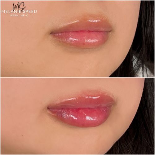 Flawless MedSpa lip filler after — Las Vegas, NV
