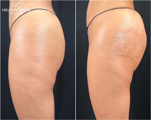 Bbl result at Flawless MedSpa