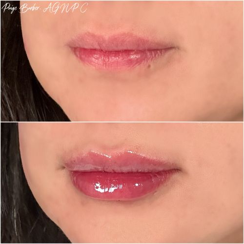 Flawless MedSpa lip filler after — Las Vegas, NV