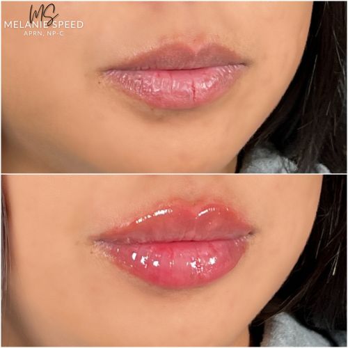 Flawless MedSpa lip filler after — Las Vegas, NV