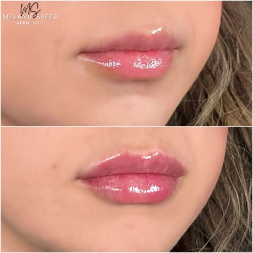 Flawless MedSpa lip filler after — Las Vegas, NV