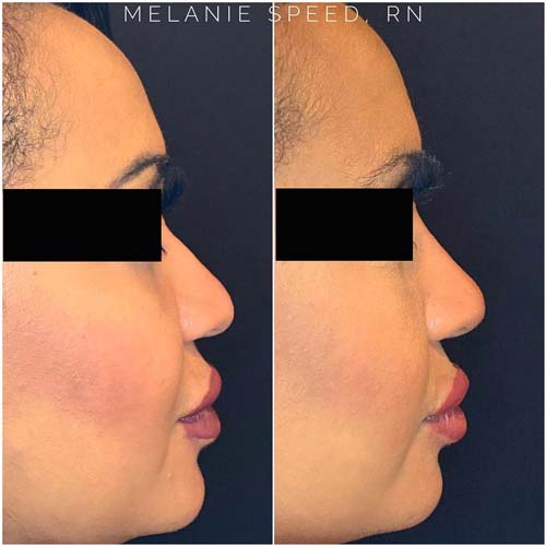 Rhinoplasty result at Flawless MedSpa