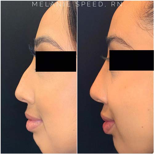 Rhinoplasty before photo