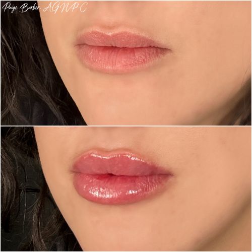 Flawless MedSpa lip filler after — Las Vegas, NV