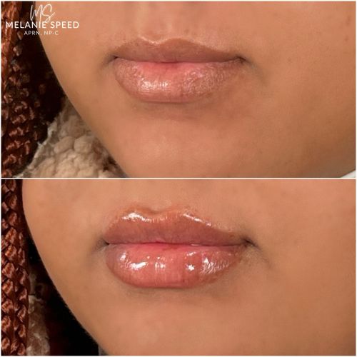 Flawless MedSpa lip filler after — Las Vegas, NV