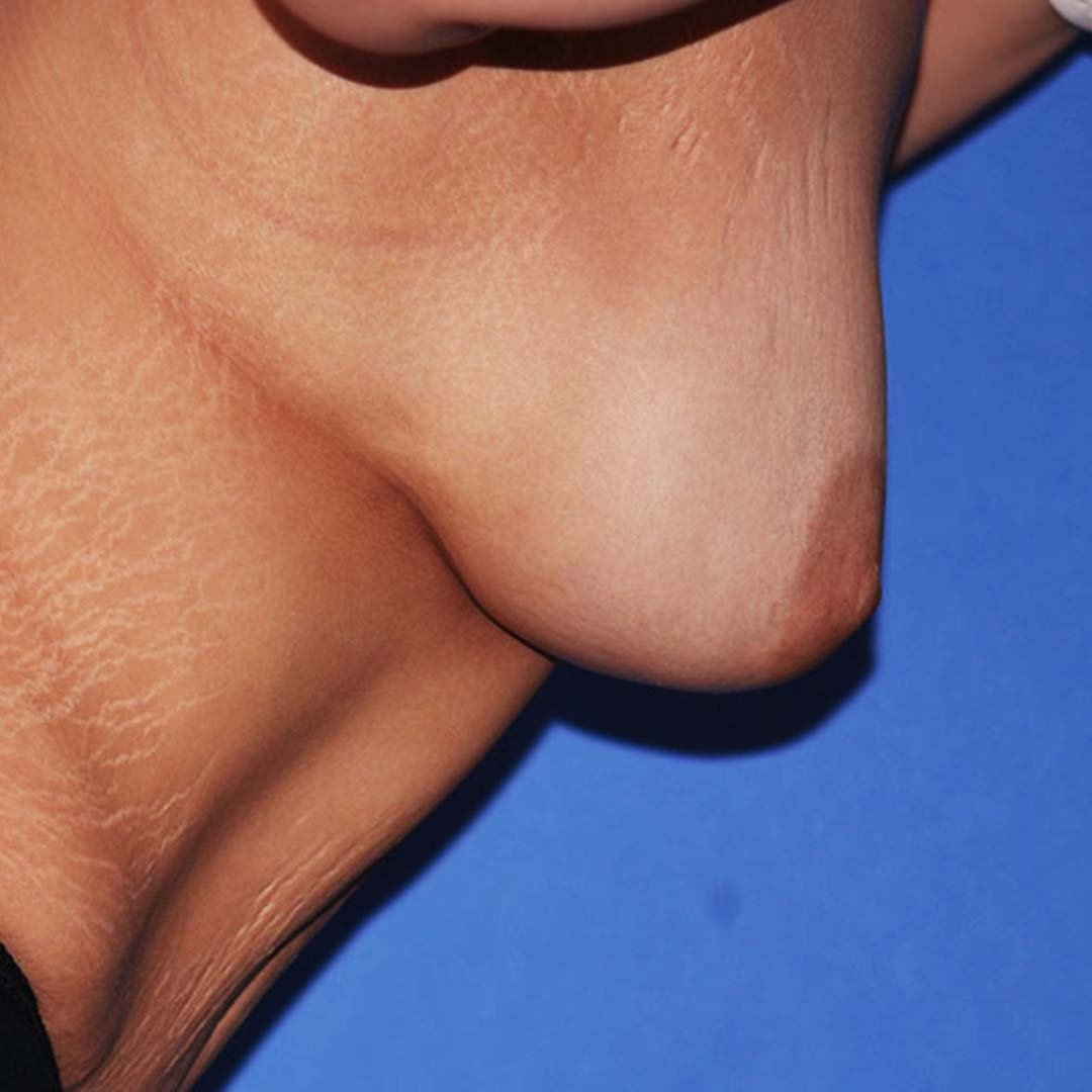 A result from Wellspring Plastic Surgery