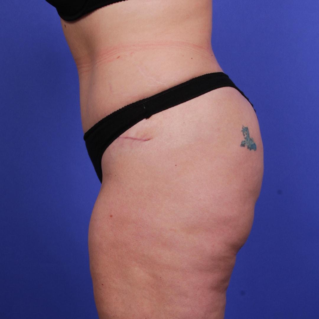 A result from Wellspring Plastic Surgery