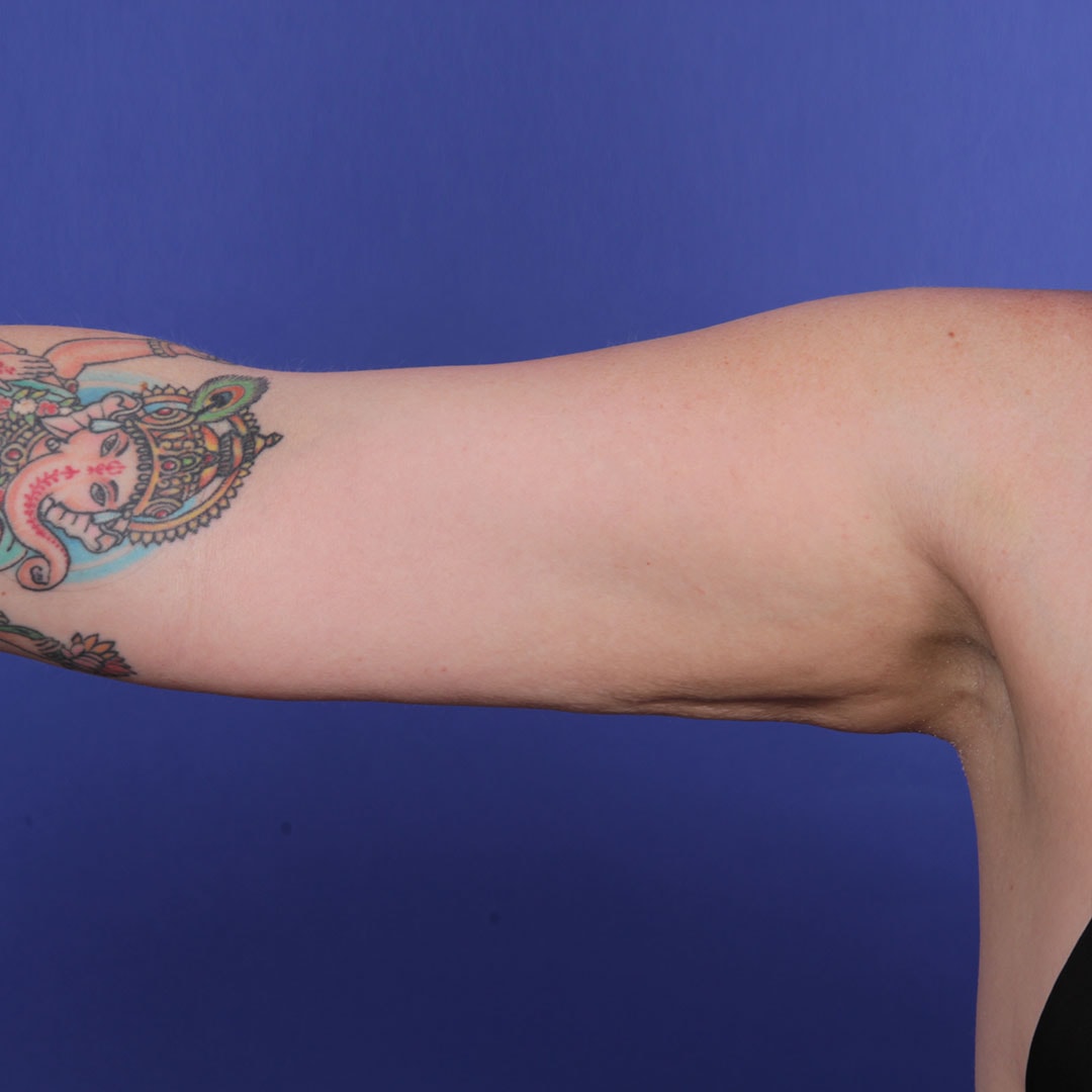 A result from Wellspring Plastic Surgery
