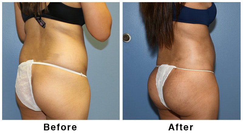 A result from Webb Plastic Surgery