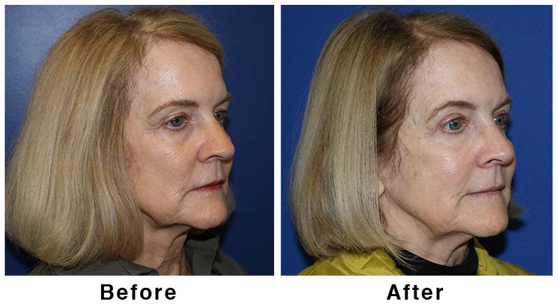 A result from Webb Plastic Surgery