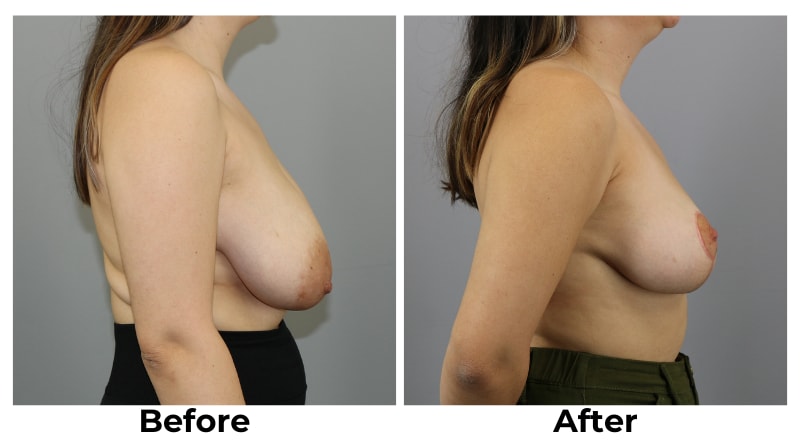 A result from Webb Plastic Surgery