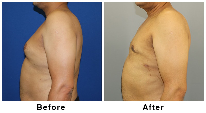 A result from Webb Plastic Surgery