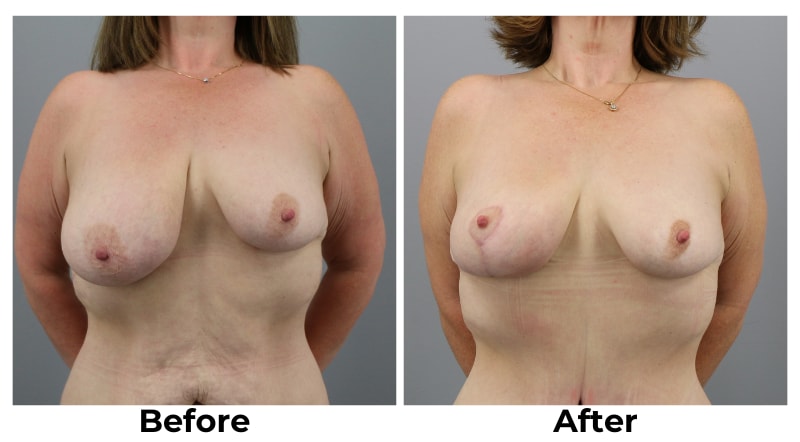 A result from Webb Plastic Surgery