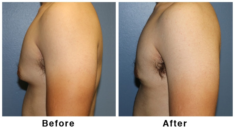 A result from Webb Plastic Surgery