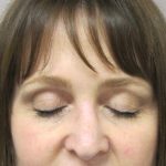 Brow Lift result at Caroline Min MD