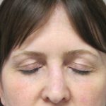 Brow Lift before photo