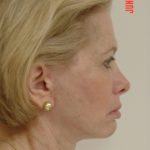 Facelift result at Caroline Min MD