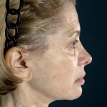 Facelift before photo