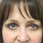 Brow Lift result at Caroline Min MD