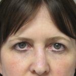 Brow Lift before photo