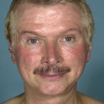 Facelift result at Caroline Min MD