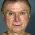 Facelift before photo