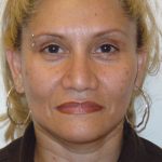 Facelift result at Caroline Min MD