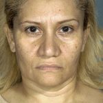 Facelift before photo