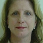 Facelift result at Caroline Min MD
