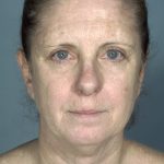 Facelift before photo
