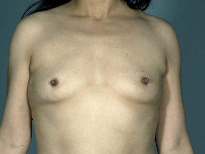Breast Augmentation before photo