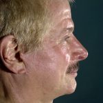 Caroline Min MD facelift after — Pasadena, CA