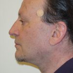 Caroline Min MD facelift after — Pasadena, CA
