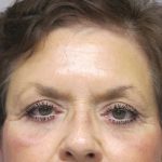 Brow Lift result at Caroline Min MD