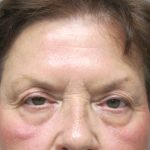 Brow Lift before photo