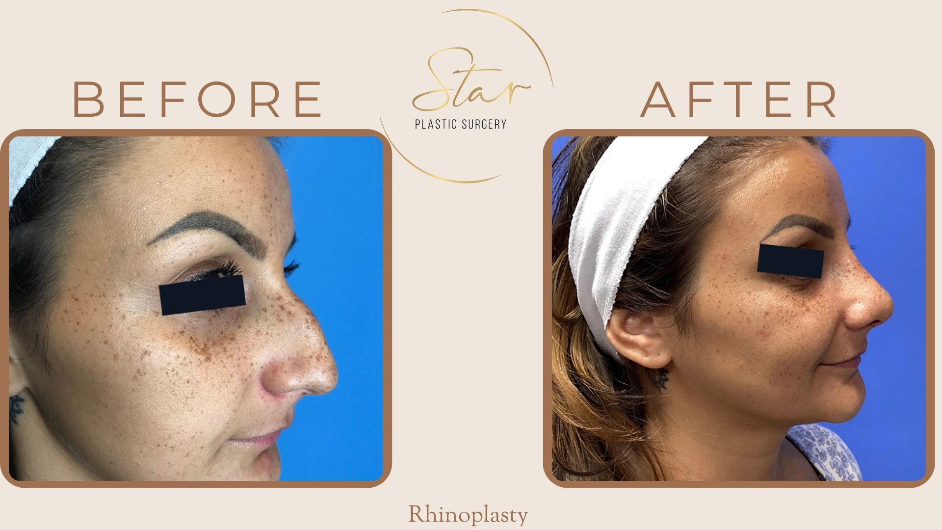 A result from Star Plastic Surgery