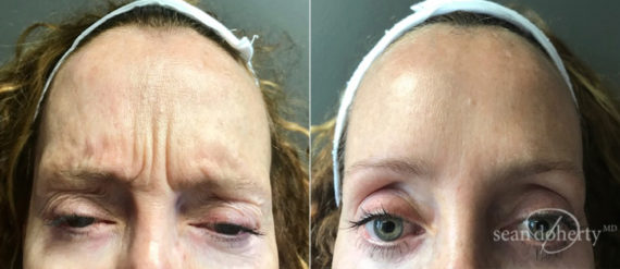 A result from Dr. Sean Doherty - Plastic Surgery