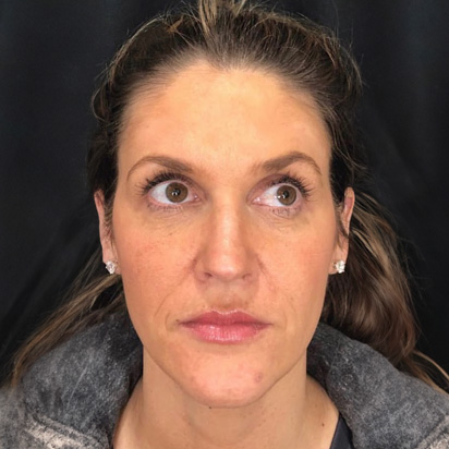 Spa Trouvé cheek filler after — Saratoga Springs, UT