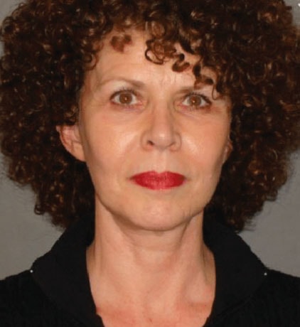 A result from Colgrove Plastic Surgery (Vinings)