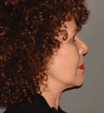 A result from Colgrove Plastic Surgery (Vinings)