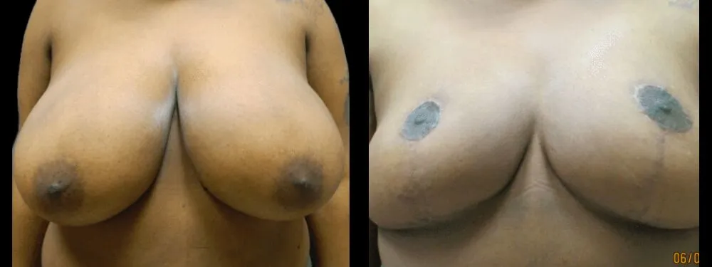 A result from Colgrove Plastic Surgery (Vinings)