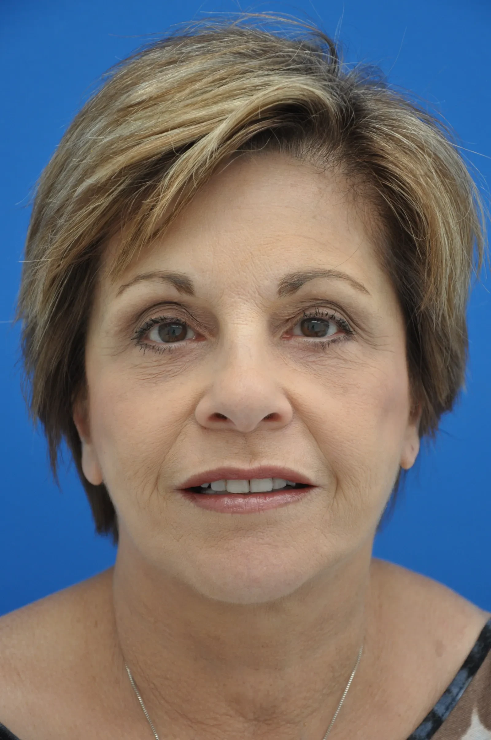 A result from Bernard A. Shuster, MD, FACS