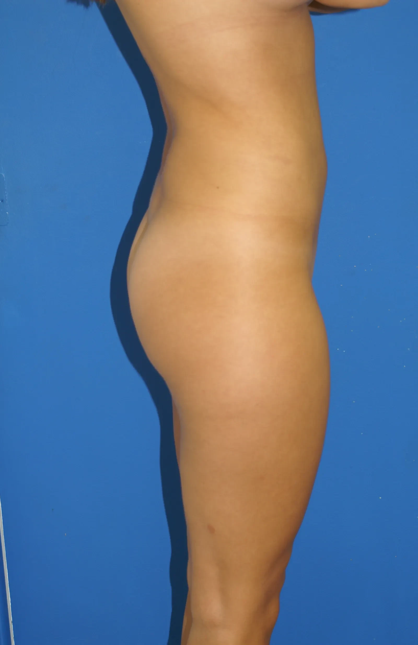 A result from Bernard A. Shuster, MD, FACS