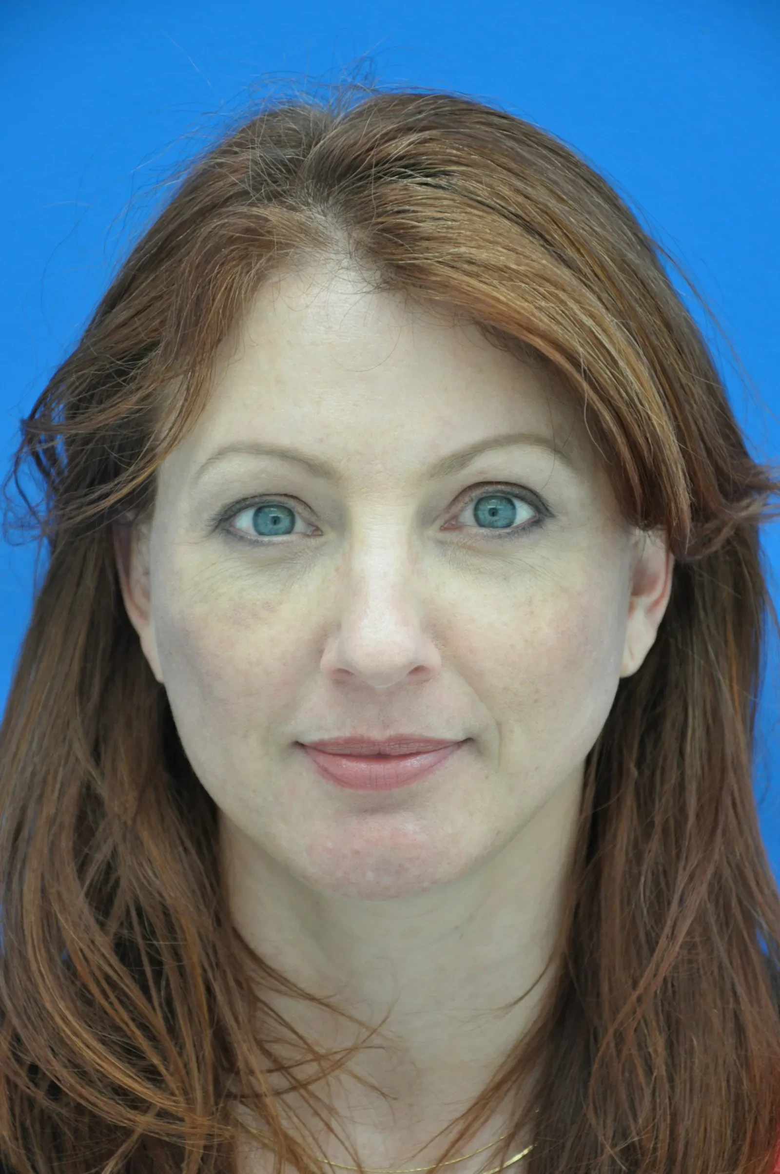 A result from Bernard A. Shuster, MD, FACS
