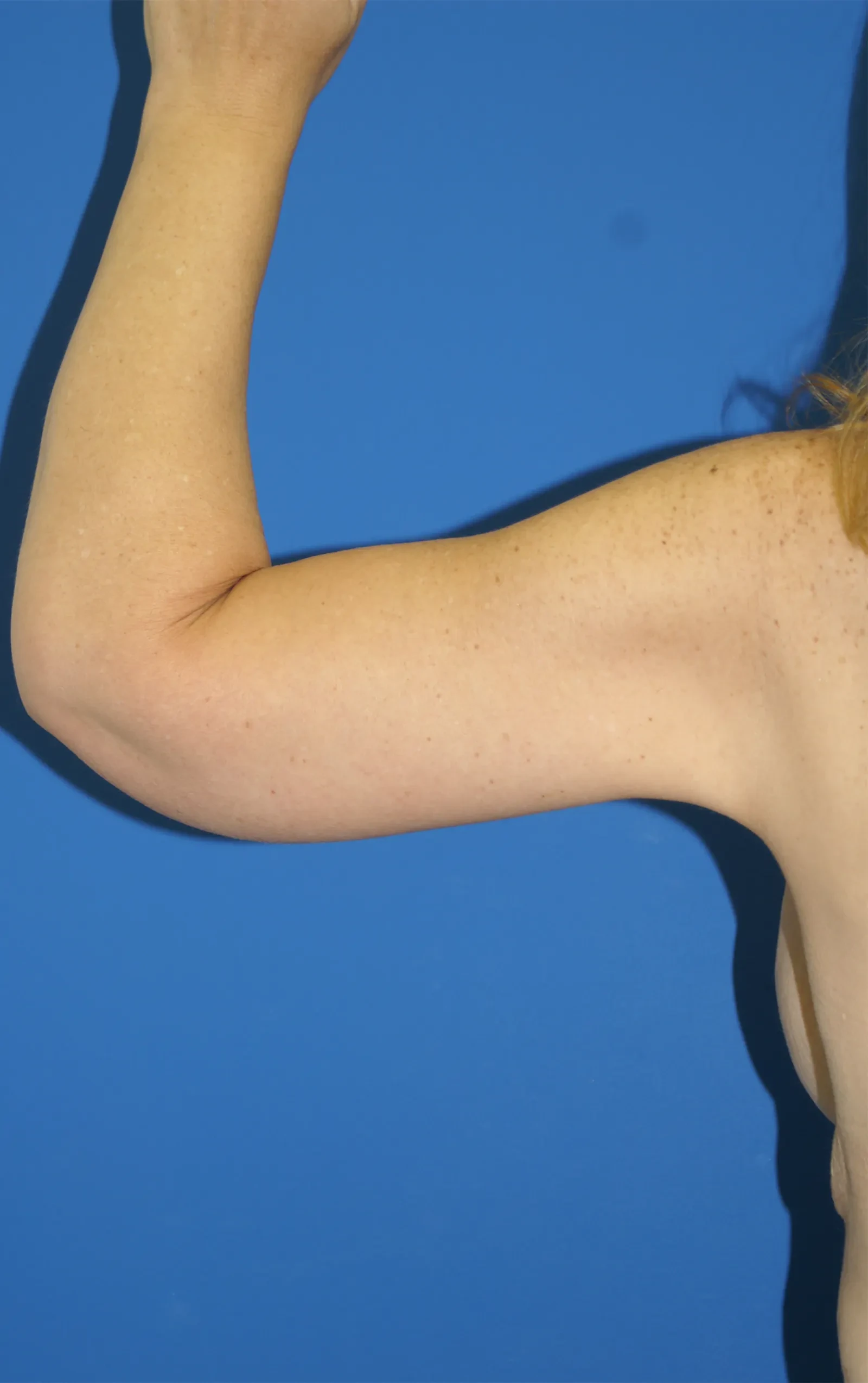 A result from Bernard A. Shuster, MD, FACS