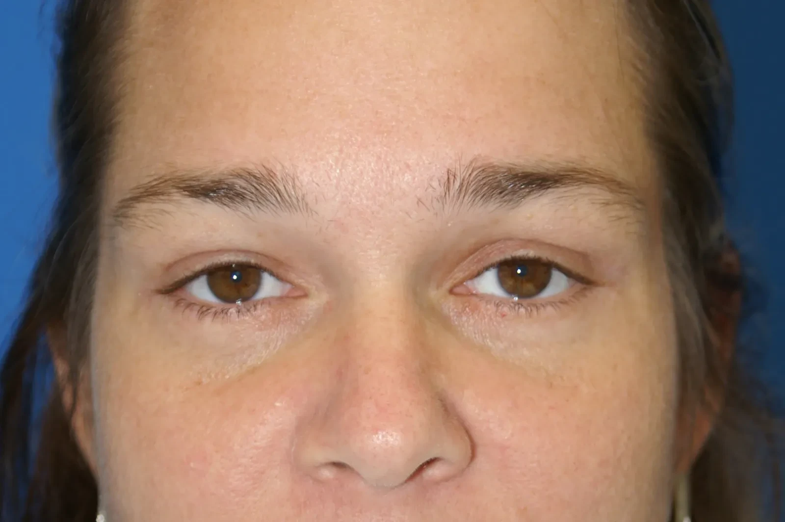 A result from Bernard A. Shuster, MD, FACS