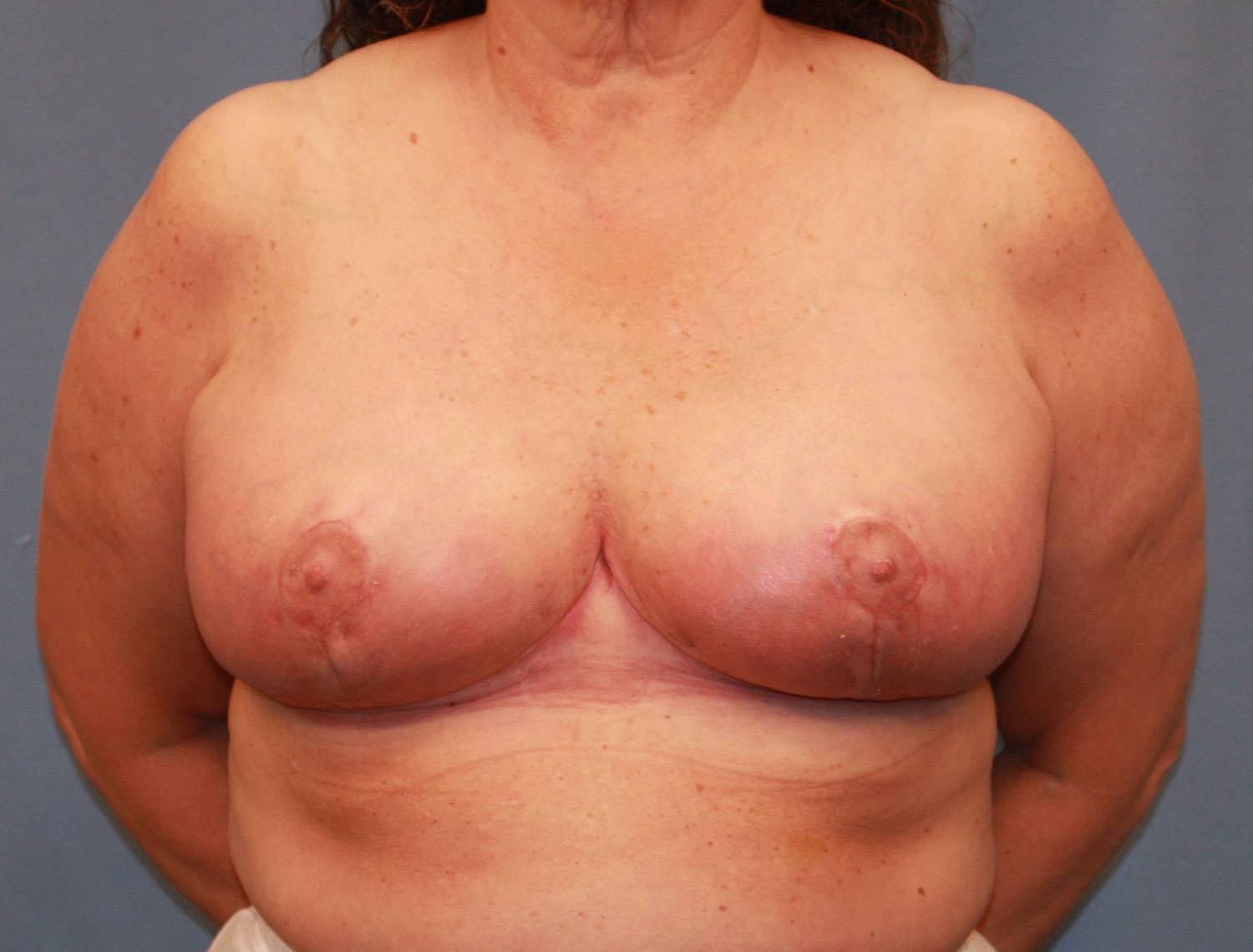 A result from Michael Spann, MD: Little Rock Plastic Surgery