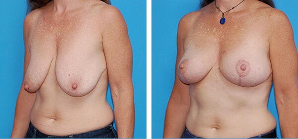 A result from Boulder Plastic Surgery